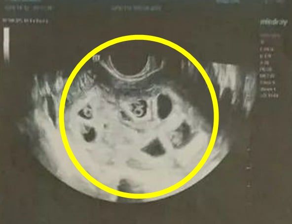 아홉 쌍둥이를 임신했던 A씨의 초음파. 사진=바이두