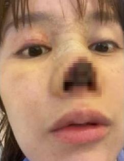  코 성형수술 부작용이 나타난 사진. 출처=데일리메일