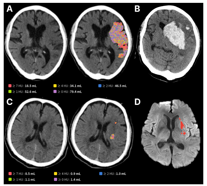 AI 뇌경색 최신 연구 논문 'Frontiers in Neuroscience' 발표 자료. <span id='_stock_code_322510' data-stockcode='322510'>제이엘케이</span> 제공