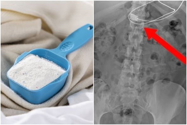 자료사진. 세탁용 가루 표백제(좌). 약 90㎝ 길이의 스마트폰 충전 케이블을 삼킨 이식증 환자의 엑스레이 사진(우). 사진=아이클릭아트·레디 투 레스큐
