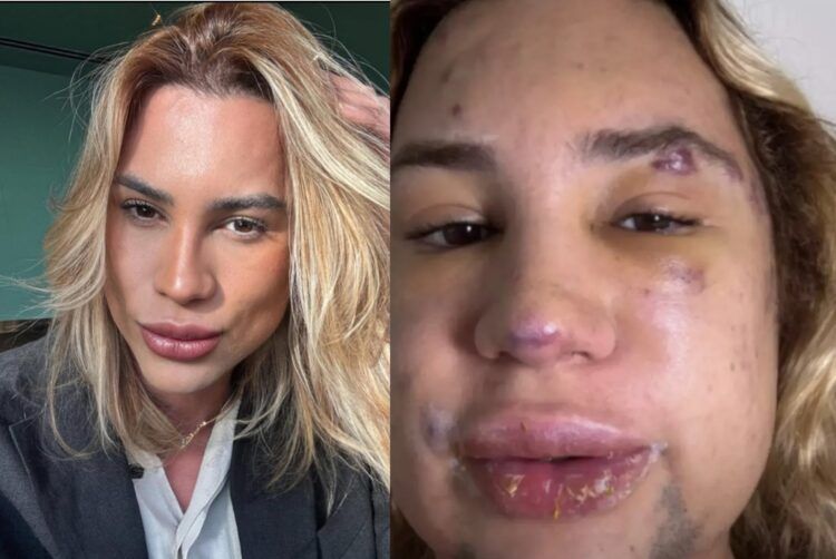 &#39;여우 눈&#39; 시술을 받고 부작용으로 사망한 패션 스타일리스트 &#39;아데이르 멘데스 두트라 주니어&#39;.  출처&#x3D;SNS, 데일리메일