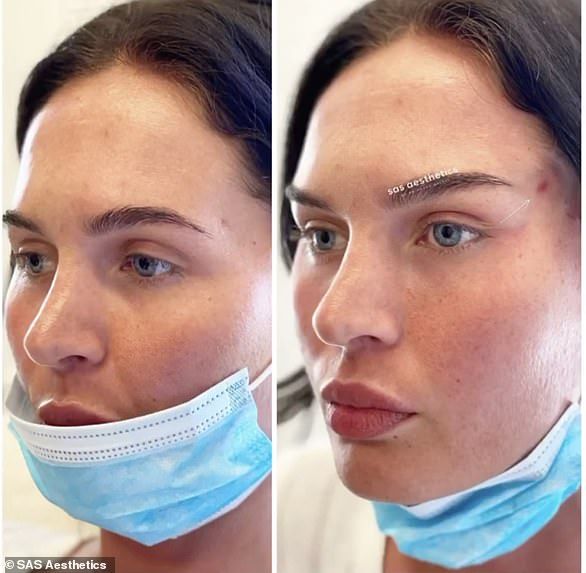 &#39;여우 눈&#39; 시술 전 후 모습.  출처&#x3D;데일리메일