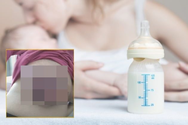 출산 후 유축기로 모유를 짜던 한 여성이 감염으로 인해 가슴 피부가 검게 썩어들어가는 충격적인 사례가 보고됐다. 배경사진=게티이미지뱅크 / 좌측 하단=멜버른 병원이 보고한 사례 PubMed Central