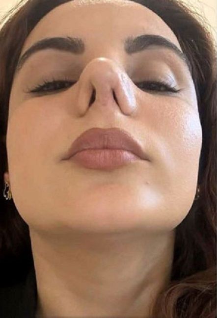 세 차례에 걸친 코 성형 수술 후 심각한 호흡 문제와 만성적인 감염으로 고통받고 있는 여성