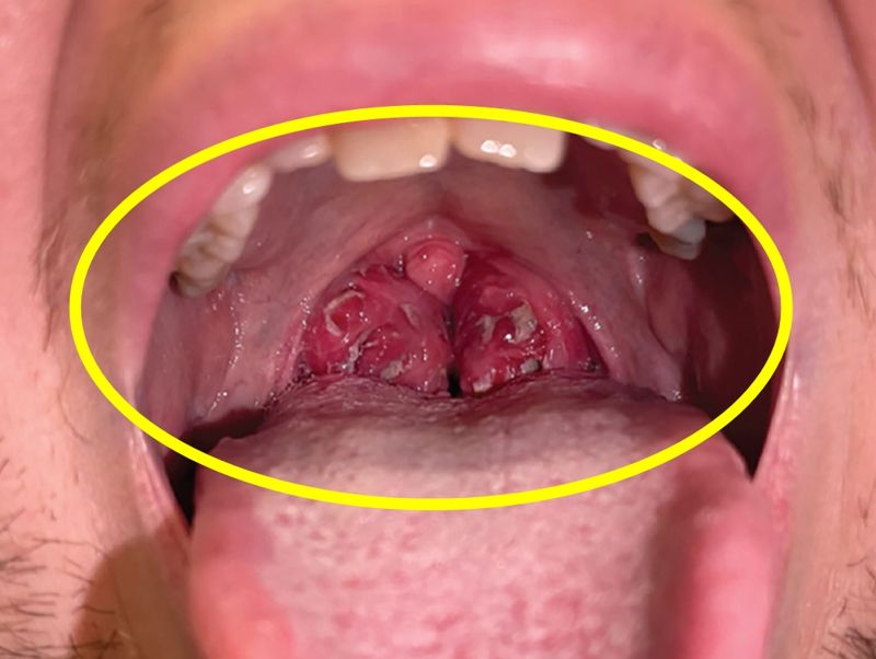감염성 단핵구증을 진단받은 남성의 편도 사진&#x2F;사진&#x3D;클리블랜드 클리닉 의학 저널 캡처