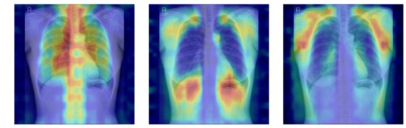 흉부X선에서 파운데이션 모델이 골다공증 판독을 위해 주목한 영역을 시각화한 이미지. 서울대병원 제공